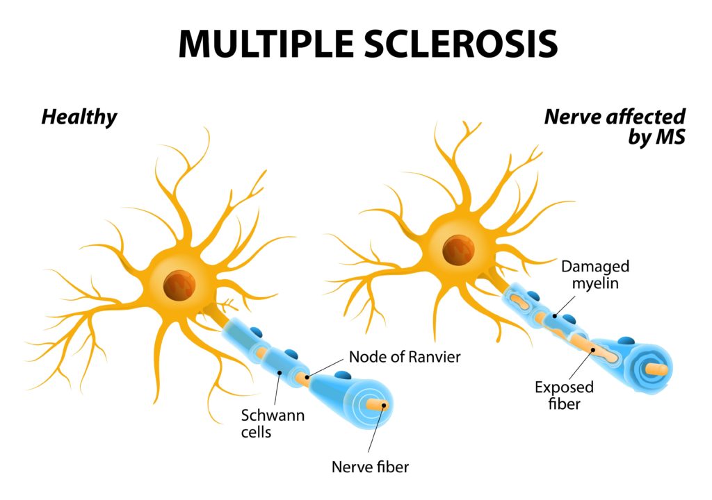 can medical marijuana help your multiple sclerosis